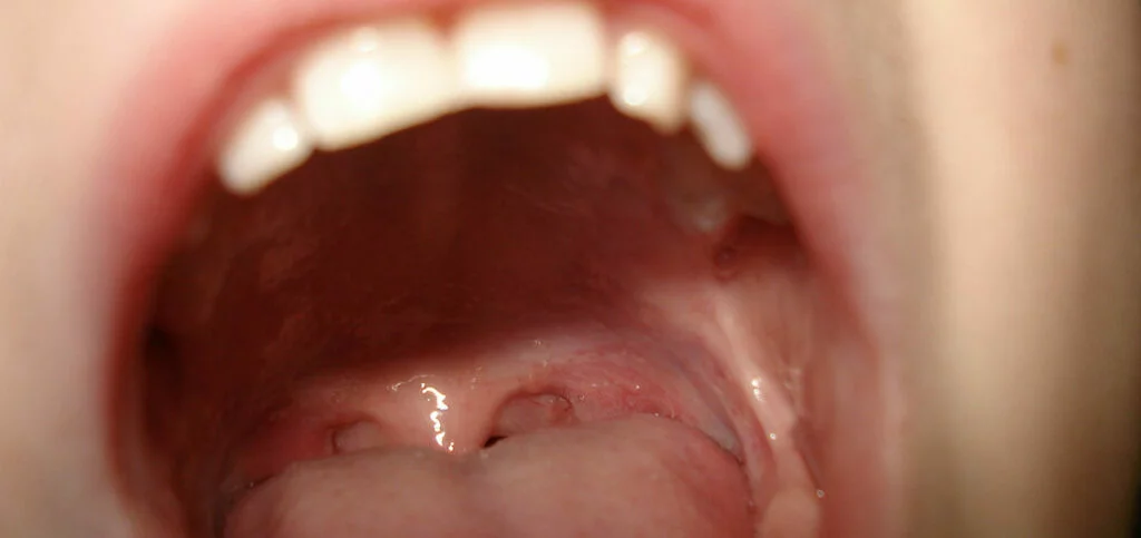 Anchiloglossia: Sintomi, Diagnosi e Trattamenti al Centro Medico Rindola