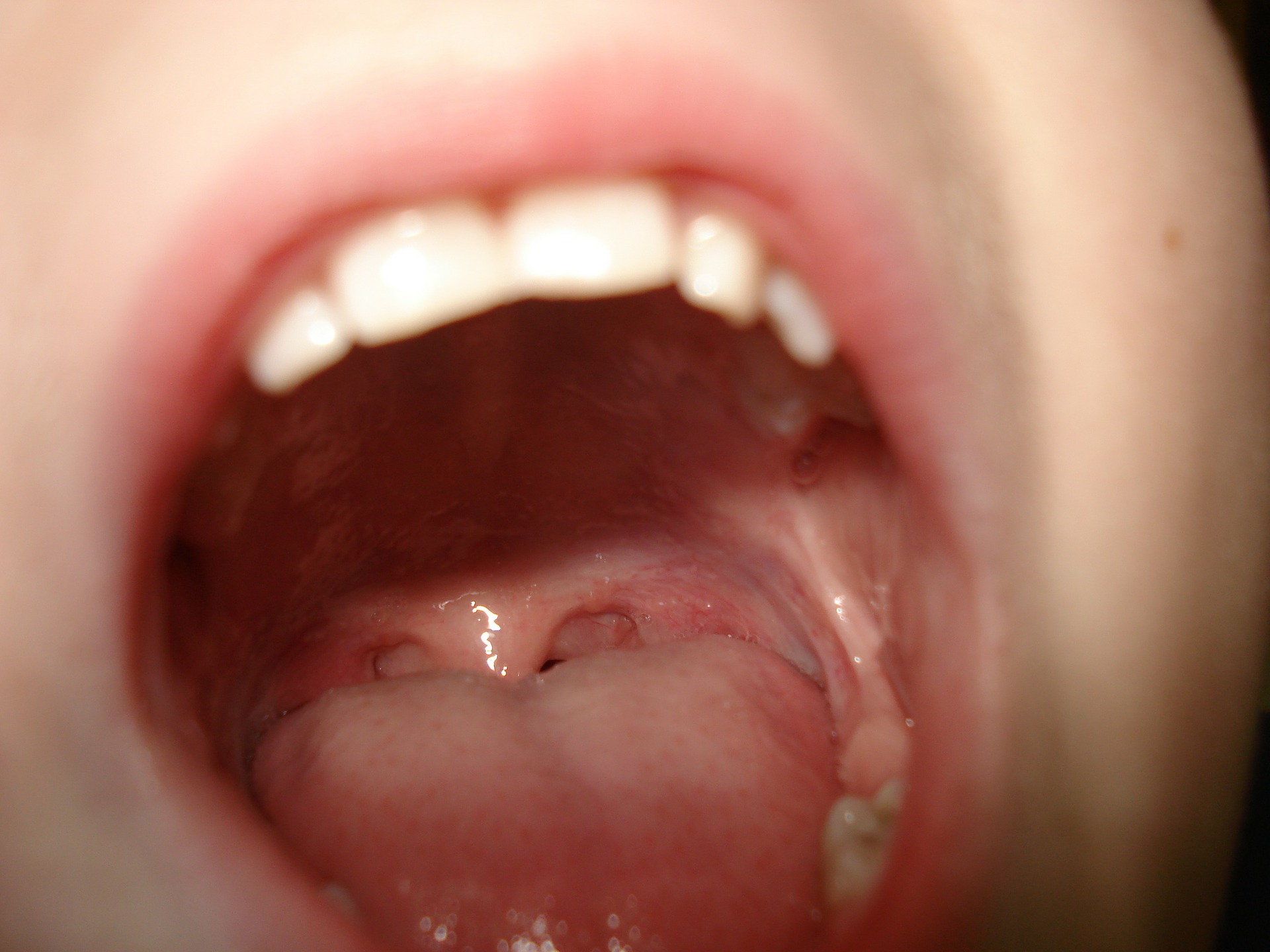 anchiloglossia immagine di bocca aperta con la lingua